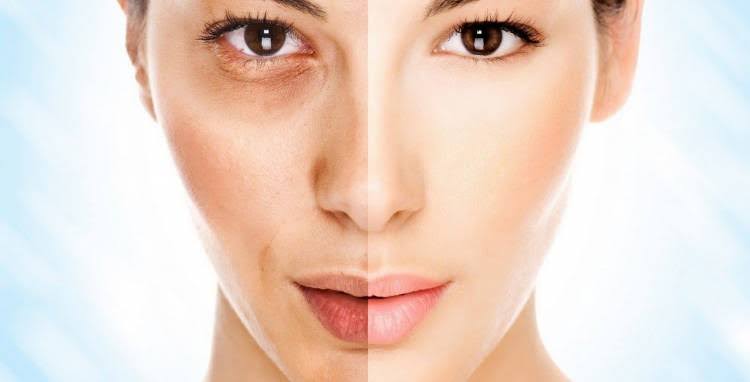 Peeling despigmentante